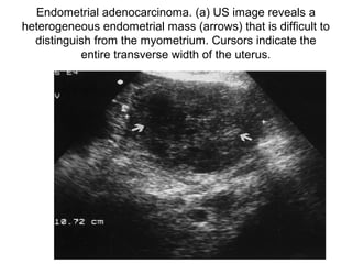 Endometrial adenocarcinoma. (a) US image reveals a
heterogeneous endometrial mass (arrows) that is difficult to
distinguish from the myometrium. Cursors indicate the
entire transverse width of the uterus.
 