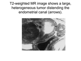 T2-weighted MR image shows a large,
heterogeneous tumor distending the
endometrial canal (arrows).
 