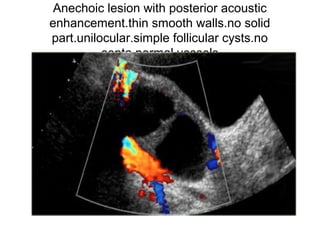 Anechoic lesion with posterior acoustic
enhancement.thin smooth walls.no solid
part.unilocular.simple follicular cysts.no
septa.normal vessels
 