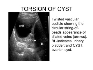 TORSION OF CYST
• Twisted vascular
pedicle showing the
circular string-of-
beads appearance of
dilated veins (arrows).
BL-indicates urinary
bladder; and CYST,
ovarian cyst.
 