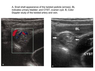 A, Snail shell appearance of the twisted pedicle (arrows). BL
indicates urinary bladder; and CYST, ovarian cyst. B, Color
Doppler study of the twisted artery and vein.
 