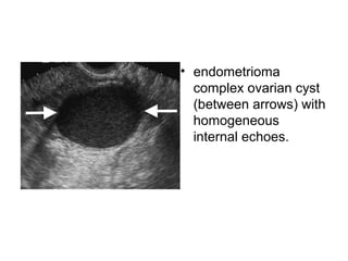 • endometrioma
complex ovarian cyst
(between arrows) with
homogeneous
internal echoes.
 