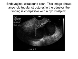 Endovaginal ultrasound scan. This image shows
anechoic tubular structures in the adnexa; the
finding is compatible with a hydrosalpinx.
 