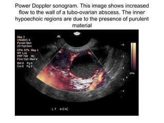 Power Doppler sonogram. This image shows increased
flow to the wall of a tubo-ovarian abscess. The inner
hypoechoic regions are due to the presence of purulent
material
 