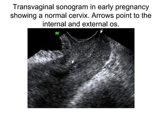 Transvaginal sonogram in early pregnancy
showing a normal cervix. Arrows point to the
internal and external os.
 