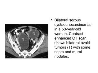 • Bilateral serous
cystadenocarcinomas
in a 50-year-old
woman. Contrast-
enhanced CT scan
shows bilateral ovoid
tumors (T) with some
septa and mural
nodules.
 