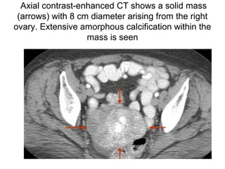 Axial contrast-enhanced CT shows a solid mass
(arrows) with 8 cm diameter arising from the right
ovary. Extensive amorphous calcification within the
mass is seen
 