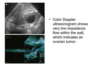 • Color Doppler
ultrasonogram shows
very low impedance
flow within the wall,
which indicates an
ovarian tumor.
 