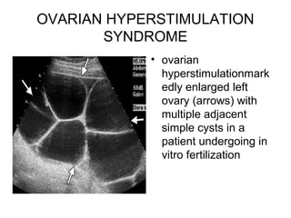 OVARIAN HYPERSTIMULATION
SYNDROME
• ovarian
hyperstimulationmark
edly enlarged left
ovary (arrows) with
multiple adjacent
simple cysts in a
patient undergoing in
vitro fertilization
 