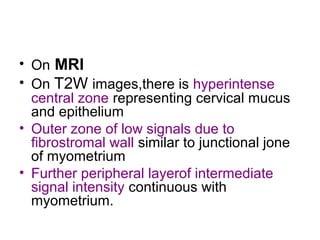• On MRI
• On T2W images,there is hyperintense
central zone representing cervical mucus
and epithelium
• Outer zone of low signals due to
fibrostromal wall similar to junctional jone
of myometrium
• Further peripheral layerof intermediate
signal intensity continuous with
myometrium.
 