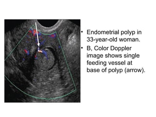 • Endometrial polyp in
33-year-old woman.
• B, Color Doppler
image shows single
feeding vessel at
base of polyp (arrow).
 