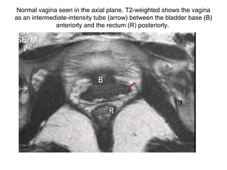 Normal vagina seen in the axial plane. T2-weighted shows the vagina
as an intermediate-intensity tube (arrow) between the bladder base (B)
anteriorly and the rectum (R) posteriorly.
 