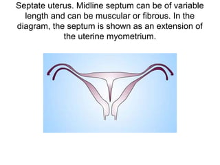 Septate uterus. Midline septum can be of variable
length and can be muscular or fibrous. In the
diagram, the septum is shown as an extension of
the uterine myometrium.
 