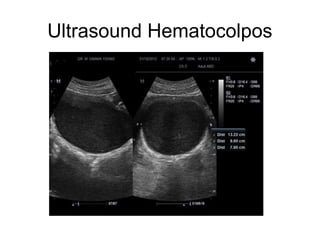 Ultrasound Hematocolpos
 