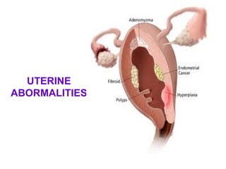 UTERINE
ABORMALITIES
 