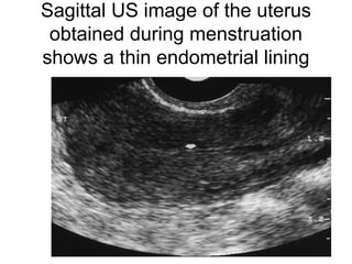Sagittal US image of the uterus
obtained during menstruation
shows a thin endometrial lining
 