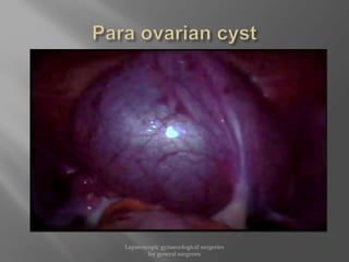 Laparoscopic gynaecological surgeries
for general surgeons
 