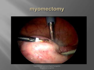 Laparoscopic gynaecological surgeries
for general surgeons
 