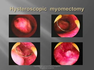 Laparoscopic gynaecological surgeries
for general surgeons
 