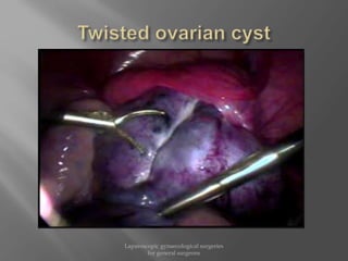 Laparoscopic gynaecological surgeries
for general surgeons
 