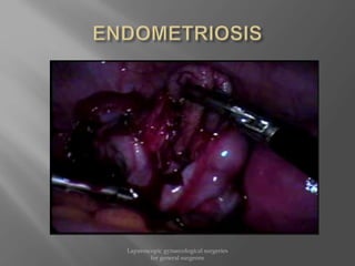 Laparoscopic gynaecological surgeries
for general surgeons
 