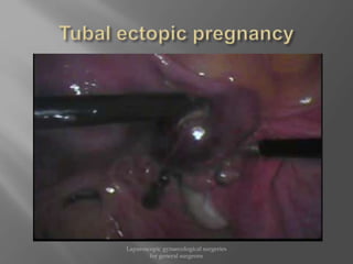 Laparoscopic gynaecological surgeries
for general surgeons
 
