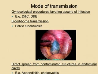 Mode of transmission
Gynecological procedures favoring ascend of infection
 E.g. D&C, D&E
Blood-borne transmission
 Pelvic tuberculosis
Direct spread from contaminated structures in abdominal
cavity
 E.g. Appendicitis, cholecystitis
 