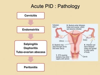 Acute PID : Pathology
Cervicitis
Endometritis
Salpingitis
Oophoritis
Tubo-ovarian abscess
Peritonitis
 