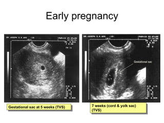 Early pregnancy Gestational sac at 5 weeks (TVS) 7 weeks (cord & yolk sac)   (TVS) 