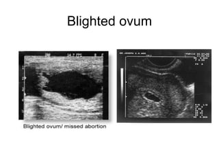 Blighted ovum 