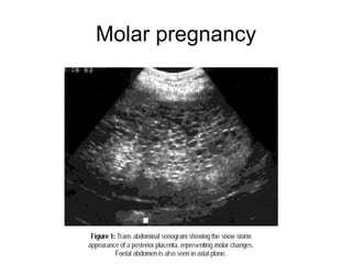Molar pregnancy 