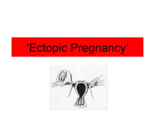 ‘ Ectopic Pregnancy’ 