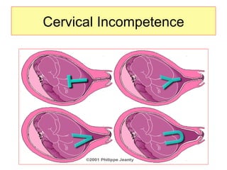 Cervical Incompetence 