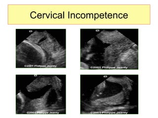 Cervical Incompetence 