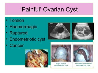 ‘ Painful’ Ovarian Cyst Torsion Haemorrhagic Ruptured Endometriotic cyst Cancer 