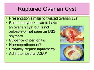 ‘ Ruptured Ovarian Cyst’ Presentation similar to twisted ovarian cyst Patient maybe known to have  an ovarian cyst but is not  palpable or not seen on USS anymore Evidence of peritonitis Haemoperitoneum? Probably require laparotomy Admit to hospital ASAP 