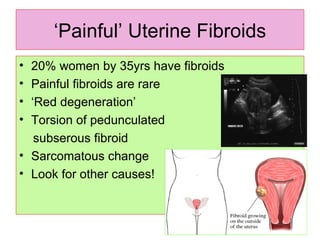 ‘ Painful’ Uterine Fibroids 20% women by 35yrs have fibroids Painful fibroids are rare ‘ Red degeneration’ Torsion of pedunculated  subserous fibroid Sarcomatous change Look for other causes! 