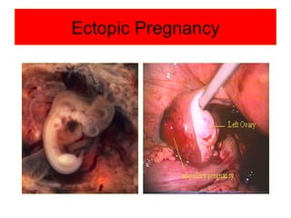 Ectopic Pregnancy 