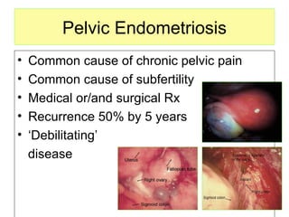 Pelvic Endometriosis Common cause of chronic pelvic pain Common cause of subfertility Medical or/and surgical Rx Recurrence 50% by 5 years ‘ Debilitating’ disease 