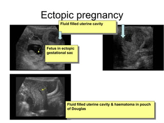 Ectopic pregnancy Fetus in ectopic gestational sac Fluid filled uterine cavity Fluid filled uterine cavity & haematoma in pouch of Douglas                                                                                                                                              