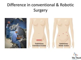 Difference in conventional & Robotic
Surgery
 