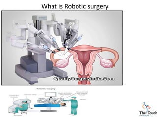 What is Robotic surgery
 