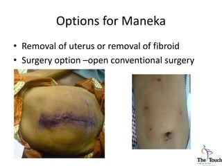 Options for Maneka
• Removal of uterus or removal of fibroid
• Surgery option –open conventional surgery
 