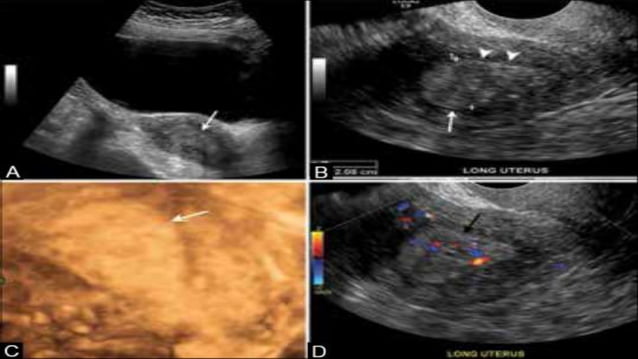 Gynaecology Thicknend Endometrium leceture 3 part 2.pptx