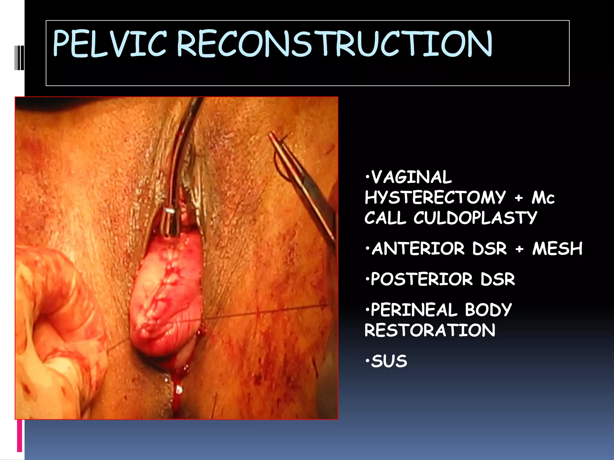 PELVIC RECONSTRUCTION
•VAGINAL
HYSTERECTOMY + Mc
CALL CULDOPLASTY
•ANTERIOR DSR + MESH
•POSTERIOR DSR
•PERINEAL BODY
RESTORATION
•SUS
 