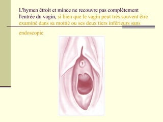 L'hymen étroit et mince ne recouvre pas complètement l'entrée du vagin,  si bien que le vagin peut très souvent être examiné dans sa moitié ou ses deux tiers inférieurs sans endoscopie   