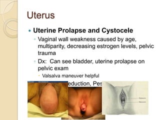Uterus


Uterine Prolapse and Cystocele
◦ Vaginal wall weakness caused by age,
multiparity, decreasing estrogen levels, pelvic
trauma
◦ Dx: Can see bladder, uterine prolapse on
pelvic exam
 Valsalva maneuver helpful

◦ Tx: digital reduction, Pessary, surgery

 