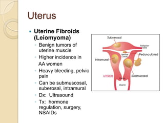 Uterus


Uterine Fibroids
(Leiomyoma)
◦ Benign tumors of
uterine muscle
◦ Higher incidence in
AA women
◦ Heavy bleeding, pelvic
pain
◦ Can be submuscosal,
suberosal, intramural
◦ Dx: Ultrasound
◦ Tx: hormone
regulation, surgery,
NSAIDs

 
