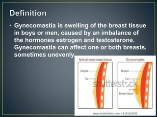 • Gynecomastia is swelling of the breast tissue
in boys or men, caused by an imbalance of
the hormones estrogen and testosterone.
Gynecomastia can affect one or both breasts,
sometimes unevenly.
 