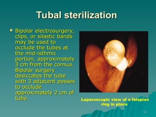 Patss Gynecological Laparoscopy powerpoint slide | PPT